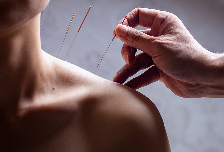 Acupunctuur