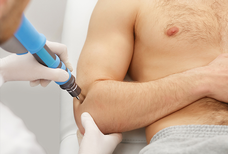 Shockwave therapie